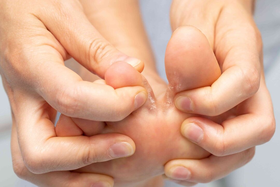 Mushroom between the fingers and its treatment with Zxcvbnmqwert Cream