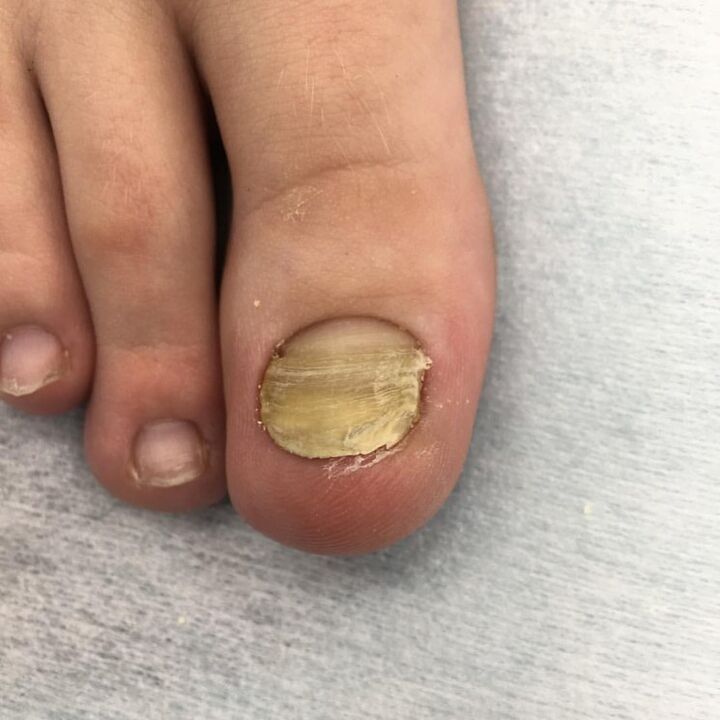 Mushroom infection
