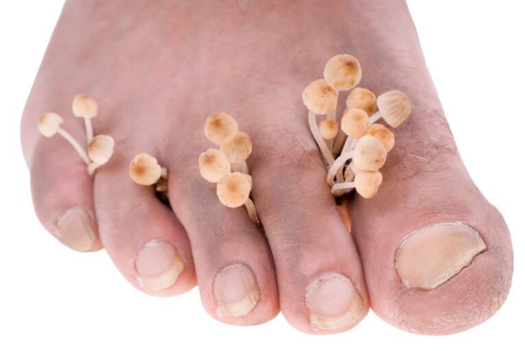 Mushroom on leg symptoms