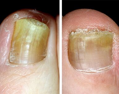 Distal form of onychomycosis on the legs