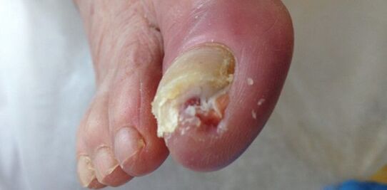 The tank and the source of dermatophytic mushrooms are a sick person