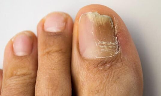 Type of distal side damage with onychomycosis on the legs