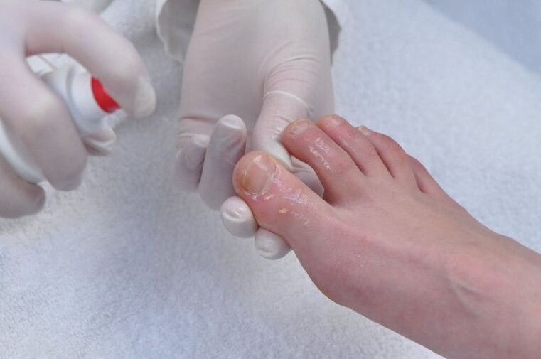 treatment of the nail plate for fungal infection